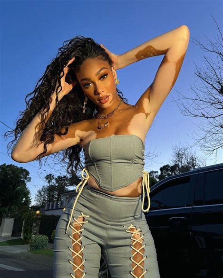 Top Vitiligo Model [vitiligo Model Name] | Inspiring Beauty